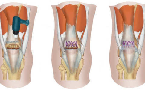 different-types-quadriceps tendon-rupture-surgery-repairs