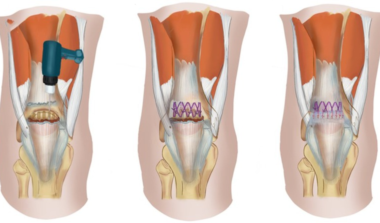 different-types-quadriceps tendon-rupture-surgery-repairs