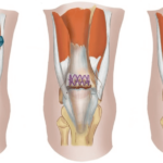 What are Different Types of Quadriceps Tendon Rupture Surgery Repairs?