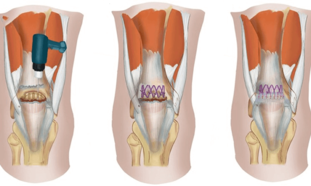 What are Different Types of Quadriceps Tendon Rupture Surgery Repairs?