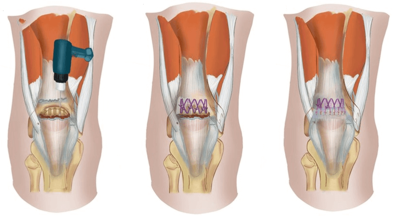 What are Different Types of Quadriceps Tendon Rupture Surgery Repairs?